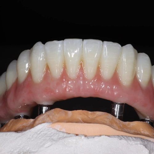 Циркониевый мост All-in-6