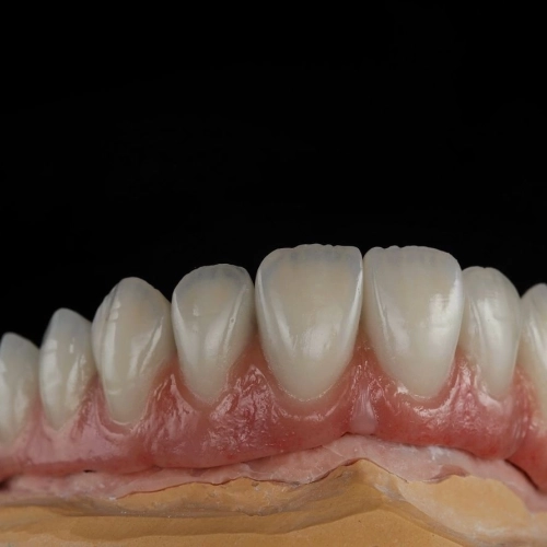 Металлокерамика All-in-6