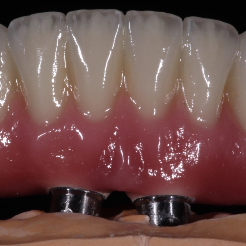 Металлокерамика All-in-4