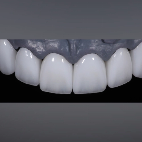 Коронки Emax с нанесением