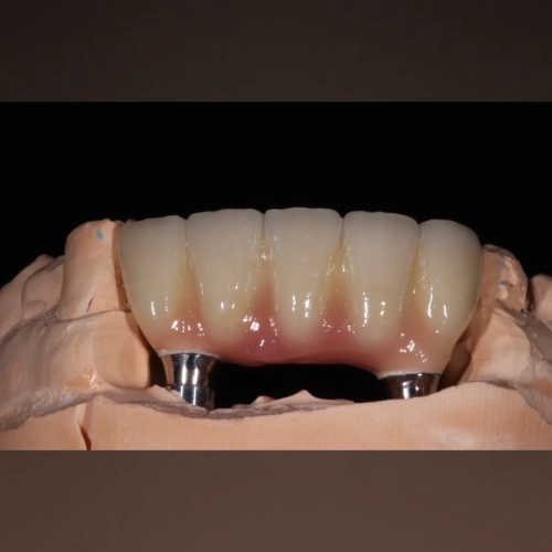 Металлокерамика на имплантах