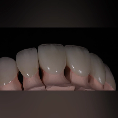 Коронки E.max с нанесением