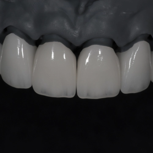 Коронки E.max с нанесением